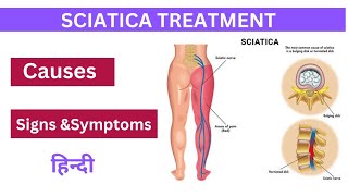 Sciatica Treatment Hindi  Cause  Signs amp Symptoms  Sciatica [upl. by Kreg]