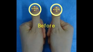 Clubbed thumbs correction [upl. by Lasala]