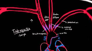 Takayasu Arteritis [upl. by Dionis504]