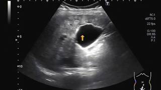 Ultrasound Video showing multiple hepatic Hemangiomas [upl. by Eki]