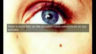 Freeze Mole Removal At Home [upl. by Yenaj]