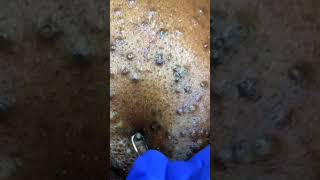 Removing large blackheads and pimples from face new 2021 23 [upl. by Nenerb449]