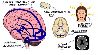 Cerebral Venous Sinus Thrombosis CVST  With Dural Venous Sinuses Anatomy [upl. by Krishnah237]