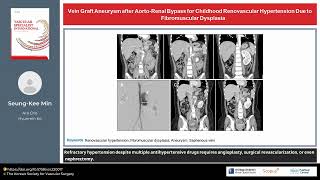 Vein Graft Aneurysm after AortoRenal Bypass for Childhood Renovascular Hypertension Due to [upl. by Kentigera888]