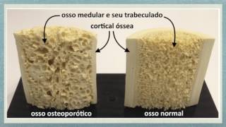 O que é a Osteoporose Como ocorre a osteoporose [upl. by Adnala]