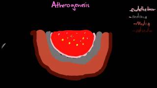 Atherogenesis part 1mp4 [upl. by Cathi]