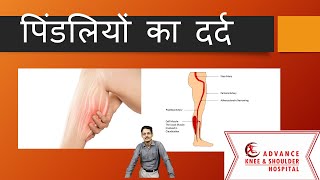 Calf PainHindi पिंडलियों का दर्द [upl. by Forelli]