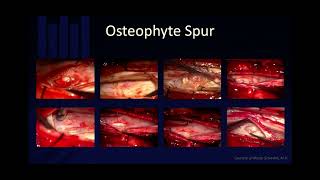 Diagnosis of csf leakspontaneous ￼intracranial hypotension is difficult Tim Amrhein MD Duke [upl. by Dirfliw]