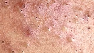 Big Cystic Acne Blackheads Extraction Blackheads amp Milia Whiteheads Removal Pimple Popping 0037💆 [upl. by Tompkins101]