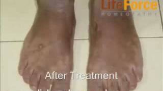 Treatment Lichen Planus on Hands amp Feet Before After Treatment Photos [upl. by Alodee150]