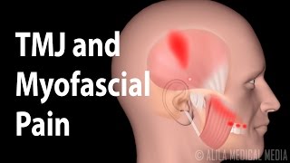 TMJ and Myofascial Pain Syndrome Animation [upl. by Dupre]