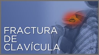 Fractura de clavícula tipos de fracturas y tratamientos [upl. by Schramke450]