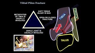 Tibial Pilon Fracture  Everything You Need To Know  Dr Nabil Ebraheim [upl. by Hanej]