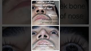 Face Nose Cheek Fat Grafting Asymmetry Correction in Delhi fatgraftingsurgery  nose  nosetip [upl. by Yirinec]