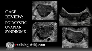 Ultrasound of Polycystic Ovarian Syndrome [upl. by Okoyik]