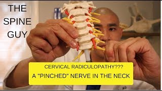 CERVICAL STENOSIS RADICULOPATHY PART 1  SYMPTOMS IMAGING AND PATIENT EXAM [upl. by Lait]