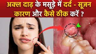 Pericoronitis Treatment At Home Akal Daad Ke Masude Fulne Ka Ilaj Wisdom Teeth Gum Swelling Remedy [upl. by Eintrok]