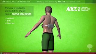 ADCC 1 and 2 braces for pectus carinatum and excavatum An Orthopectus invention [upl. by Bartram]