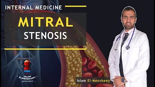 Mitral Stenosis  MS [upl. by Rubenstein]