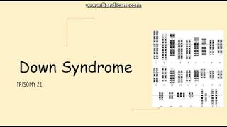 Trisomy 21 Down syn Genetics Pathology Clinical Symptoms and Diagnosis [upl. by Bisset]