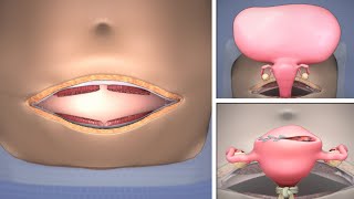 Abdominal Myomectomy through Maylard incision  TVASurg [upl. by Sapienza]