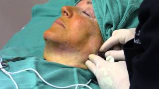 ThermiTight  ThermiRF Treatment for Neck Laxity and Sagging  Radiofrequency RF Neck Tightening [upl. by Boru]