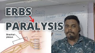 Erbs Paralysis detailed information [upl. by Ruthann]