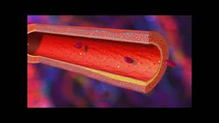 Infarctus du myocarde  IDM [upl. by Kohl]