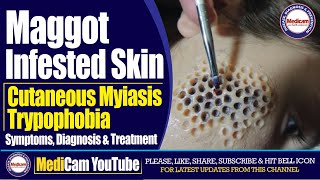 Maggot Infested Skin  Cutaneous Myiasis And Trypophobia  Diagnosis And Treatment  Medicam YouTube [upl. by Menis242]