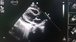 effuso constrictive pericarditis echocardiography [upl. by Dirtsa641]