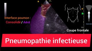 Pneumopathie Consolidation Échographie pulmonaire [upl. by Dario]