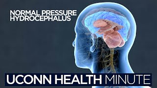 UConn Health Minute Normal Pressure Hydrocephalus [upl. by Tansey206]