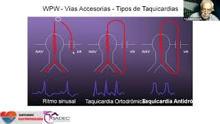 14  Taquicarida Paroxística Supraventricular TPS diagnósticos diferenciales [upl. by Tybi581]