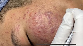 Blackheads amp Pimples Pore Removal New 2024  Acne Treatment With Bo Nguyễn Spa 024 [upl. by Madancy162]