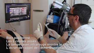 Traitement des varices par scléroses échoguidées 042017 avec repérage à la lampe laser infrar [upl. by Ahpla]