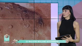 LE MALATTIE BOLLOSE AUTOIMMUNI [upl. by Ennasil]