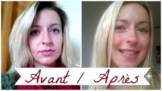 ACNE ❀ Roacutane mois après mois [upl. by Ruhnke27]