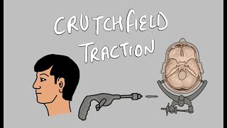 How to apply Cervical traction  Crutchfield Traction [upl. by Lura847]