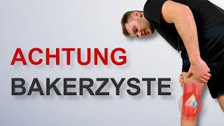 Bakerzyste  Das musst du wissen [upl. by Mann]