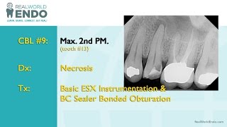 CBL 9 Basic ESX Instrumentation and Obturation [upl. by William]