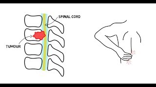 Spinal Cord Compression [upl. by Sicular194]