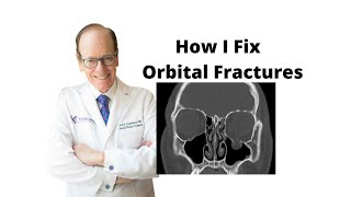 Orbital Fractures 101  Oculoplastic Surgeon Explains Orbital Fracture Surgery [upl. by Kylander256]