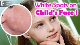 5 Things to know if your child is suffering from Pityriasis Alba  Dr Divya SharmaDoctors Circle [upl. by Binetta]