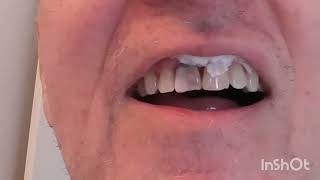 How to fix a chipped front tooth [upl. by Amilah169]