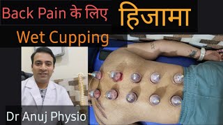 Hijama Wet Cupping for back pain backpain cuppingtherapy [upl. by Kcirddet]