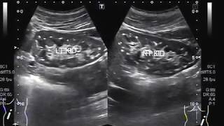 Ultrasound Video showing bilateral renal microlithiasis [upl. by Eceela]