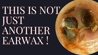 WATCH CAREFULLY This is not just another earwax [upl. by Ydur]