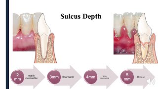 Periodontal Pocket  Part 1 [upl. by Ahsinrac]