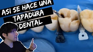 🦷😁Como se HACE una TAPADURA DENTAL 🦷😁Reaccionando a compilado de RESTAURACIONES N°1 [upl. by Noiraa]