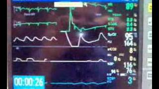 DC Cardioversion of SVT [upl. by Thomey683]